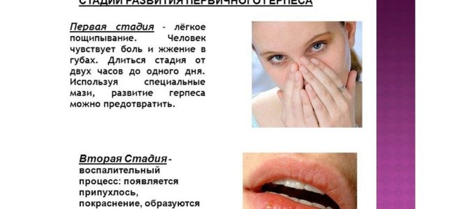 Лечение герпеса - особенности